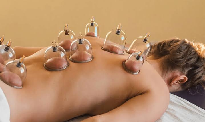 Cupping Therapy