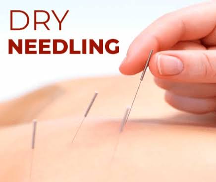 Dry Needling